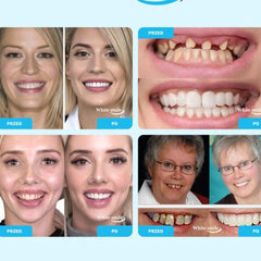 SMILEFIT PRO – ÁLLÍTHATÓ FOGPÓTLÁS KÉSZLET A TÖKÉLETES MOSOLYÉRT